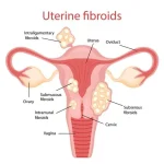 An objective examination of UFE and hysterectomy