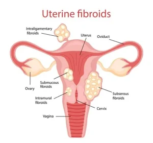 An objective examination of UFE and hysterectomy